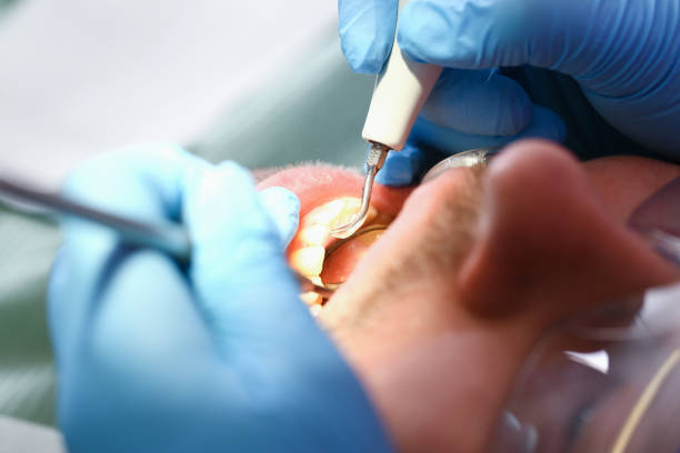 Best Emergency Tooth Extraction in Galva, IL